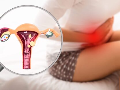 Endometrióza -Hormonálne zmeny vášho menštruačného cyklu ovplyvňujú nesprávne umiestnené tkanivo podobné endometriu, čo spôsobuje, že sa oblasť zapáli a bude bolestivá. To znamená, že tkanivo bude rásť, hrubnúť a rozpadať sa. V priebehu času sa tkanivo, ktoré sa rozpadlo, nemá kam dostať a uviazne vo vašej panve. Endometrióza je chronický stav, ktorý je idiopatický, čo znamená, že sa ešte musí určiť, čo ho spôsobuje. A momentálne nemá liek. K dispozícii sú však účinné liečby, ako sú lieky, hormonálna terapia a chirurgia, ktoré pomáhajú zvládnuť vedľajšie účinky a komplikácie, ako sú bolesti a problémy s plodnosťou. A príznaky endometriózy sa zvyčajne zlepšujú po menopauze.