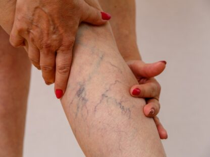 metličkové žilky elderly,woman,in,white,panties,shows,cellulite,and,varicose,veins