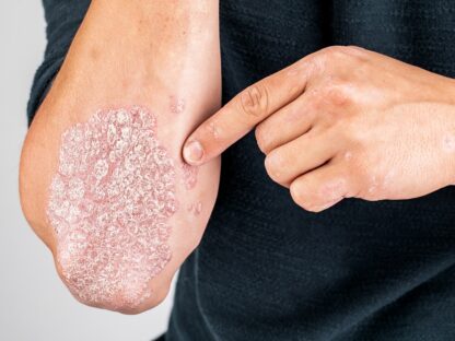 Psoriáza je autoimunitné ochorenie, ktoré spôsobuje, že telo produkuje kožné bunky vo zvýšenej miere. Hlavná príčina psoriázy je nejasná