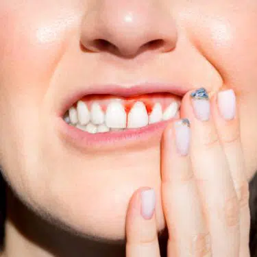 paradentóza paradontída alebo ochorenie ďasien je bežnou infekciou, ktorá poškodzuje mäkké tkanivá a kosti podporujúce zub. Bez liečby sa alveolárna kosť okolo zubov pomaly a postupne stráca.