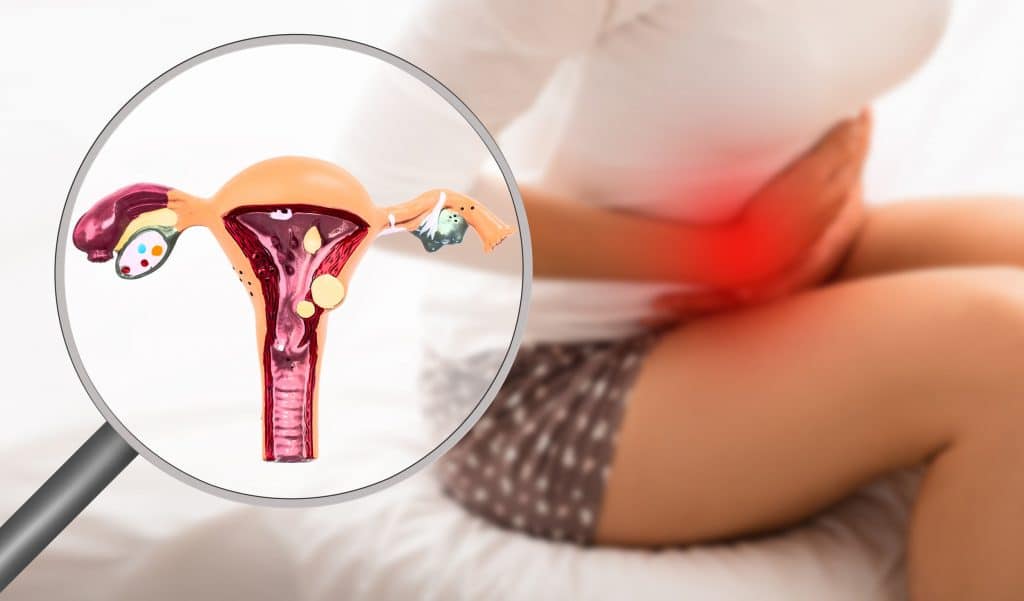 Endometrióza -Hormonálne zmeny vášho menštruačného cyklu ovplyvňujú nesprávne umiestnené tkanivo podobné endometriu, čo spôsobuje, že sa oblasť zapáli a bude bolestivá. To znamená, že tkanivo bude rásť, hrubnúť a rozpadať sa. V priebehu času sa tkanivo, ktoré sa rozpadlo, nemá kam dostať a uviazne vo vašej panve. Endometrióza je chronický stav, ktorý je idiopatický, čo znamená, že sa ešte musí určiť, čo ho spôsobuje. A momentálne nemá liek. K dispozícii sú však účinné liečby, ako sú lieky, hormonálna terapia a chirurgia, ktoré pomáhajú zvládnuť vedľajšie účinky a komplikácie, ako sú bolesti a problémy s plodnosťou. A príznaky endometriózy sa zvyčajne zlepšujú po menopauze.